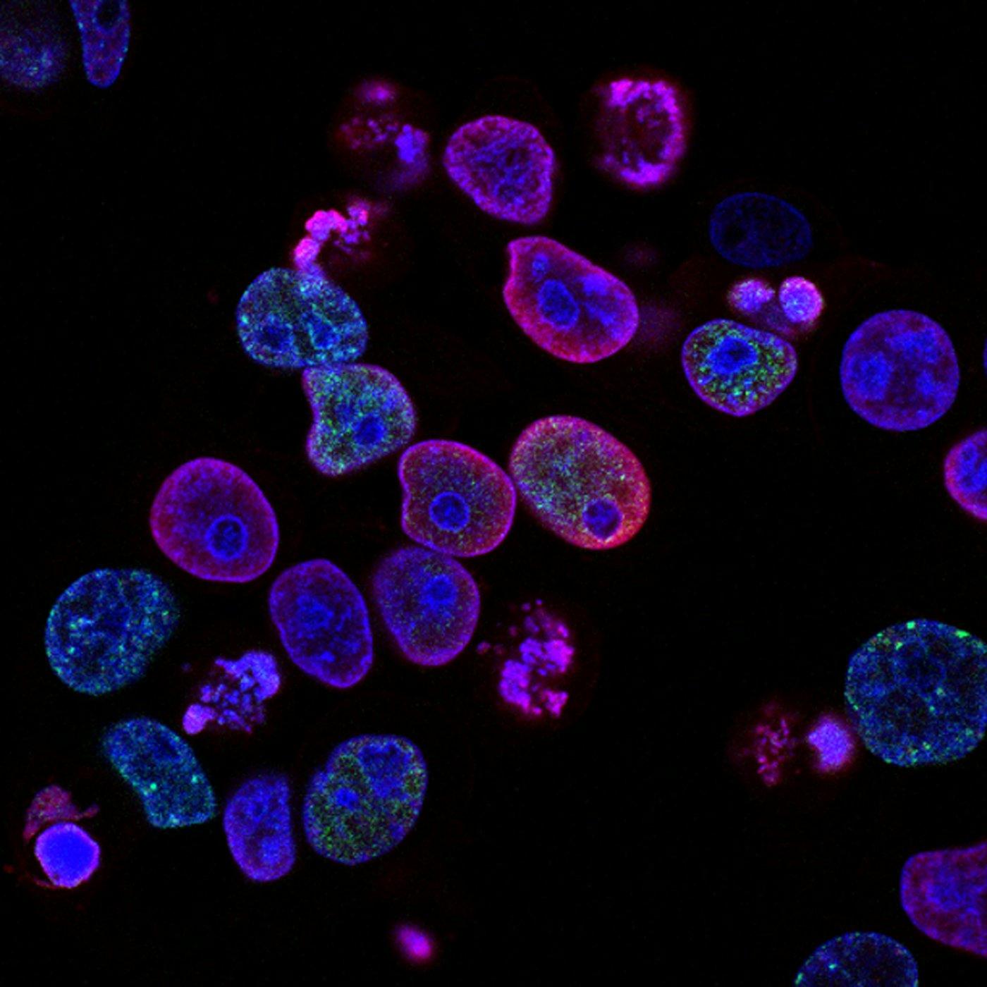 Fluorescence microscopy image of cancer cells with stained nuclei